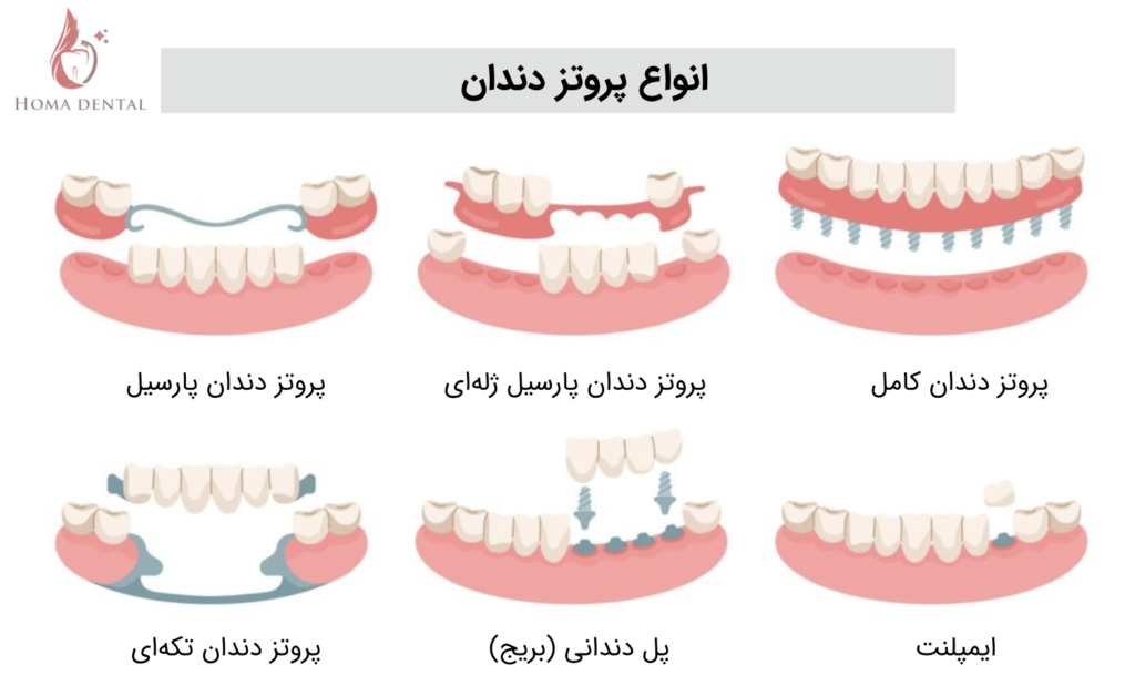 ۶ نوع پروتز دندان ثابت و متحرك