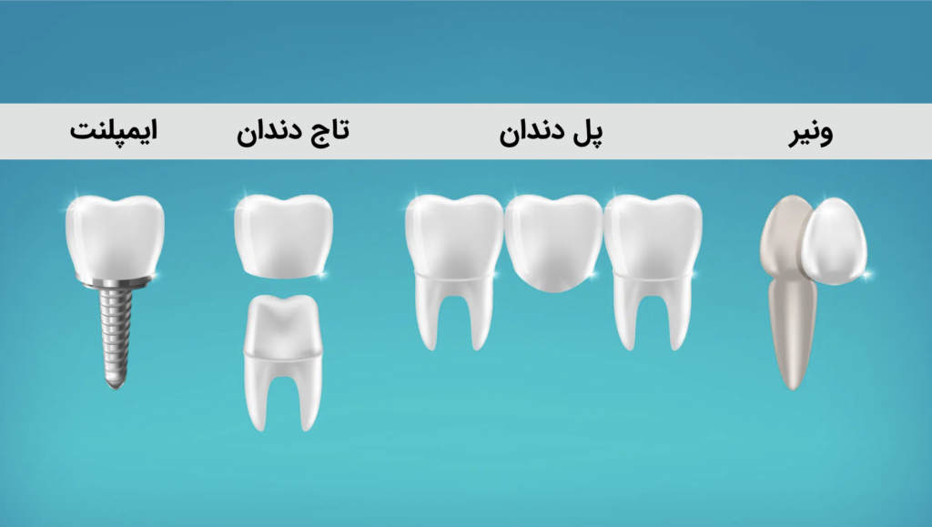 انواع پروتز دندان ثابت