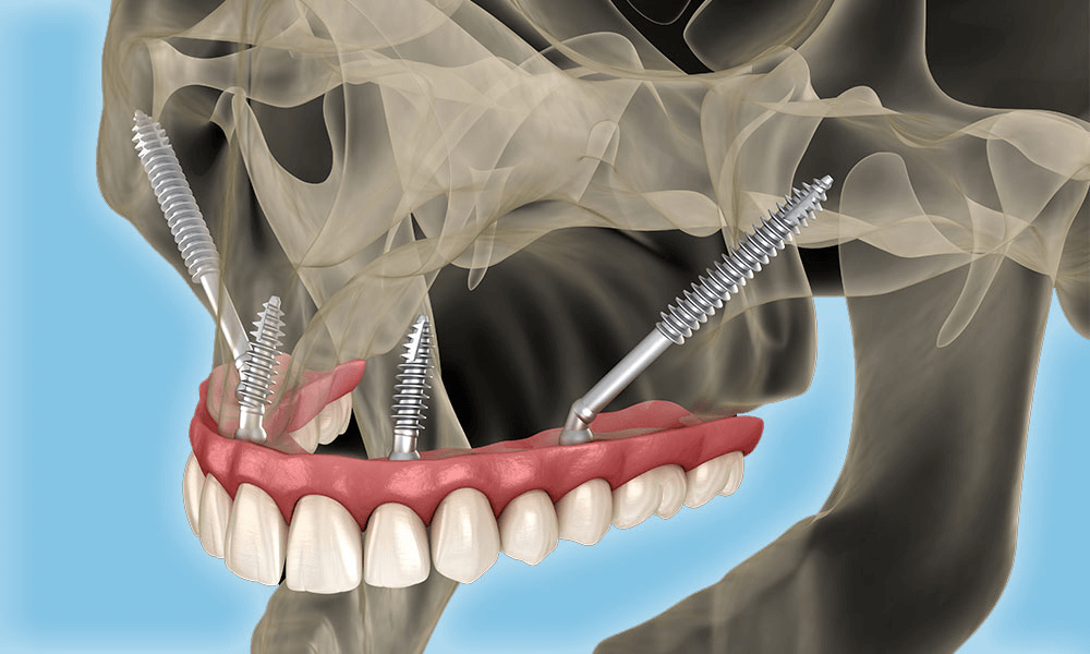 ایمپلنت‌های زیگوماتیک (Zygomatic)