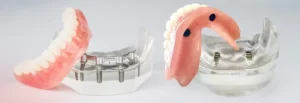 پروتز دندان اصلاح‌شده (Implant-Supported Denture)