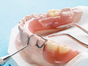 پروتز دندان پارسیل (Partial Denture)