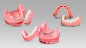 پروتز دندان اوردنچر (Overdenture)