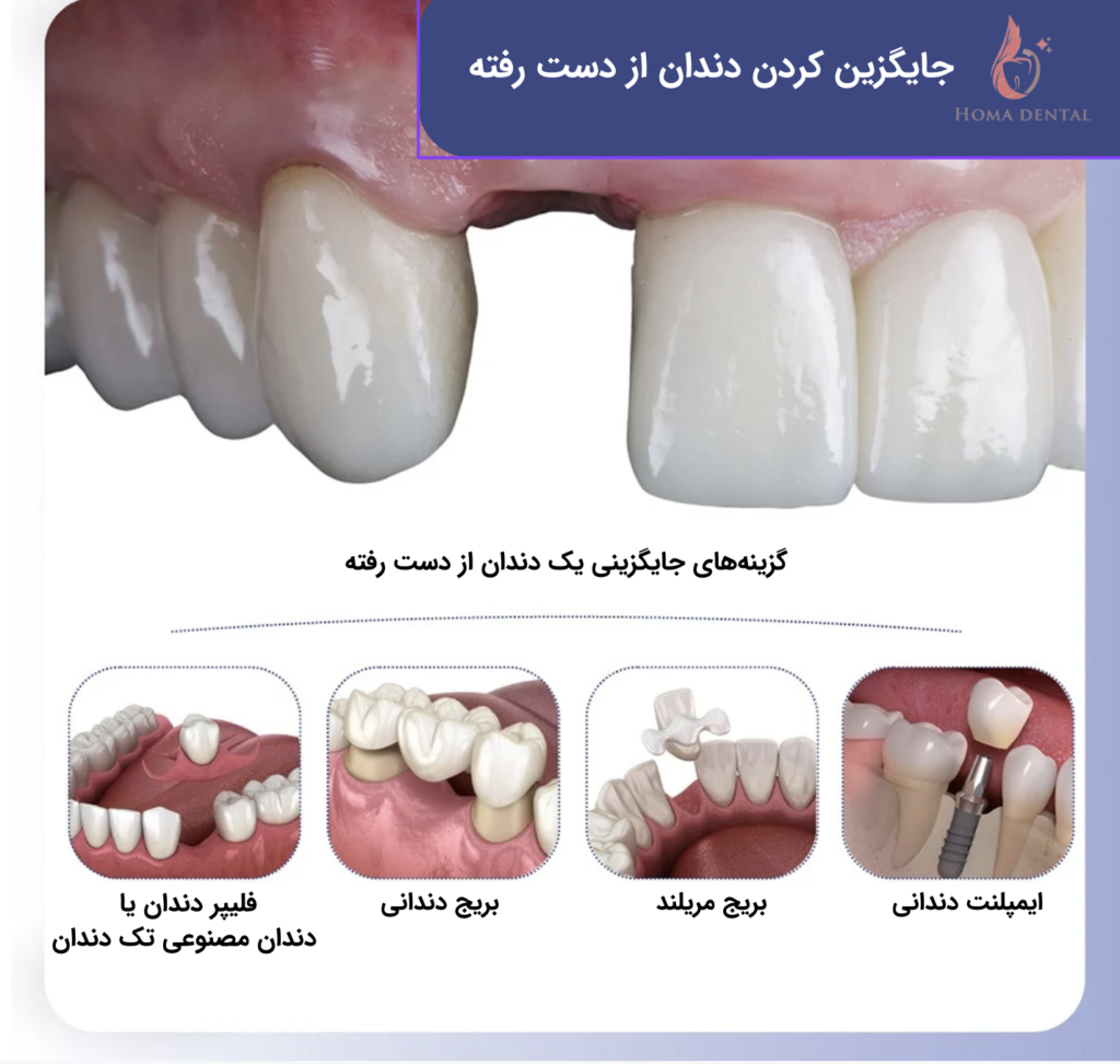 معرفی روش های جایگزینی تک دندان از دست رفته 