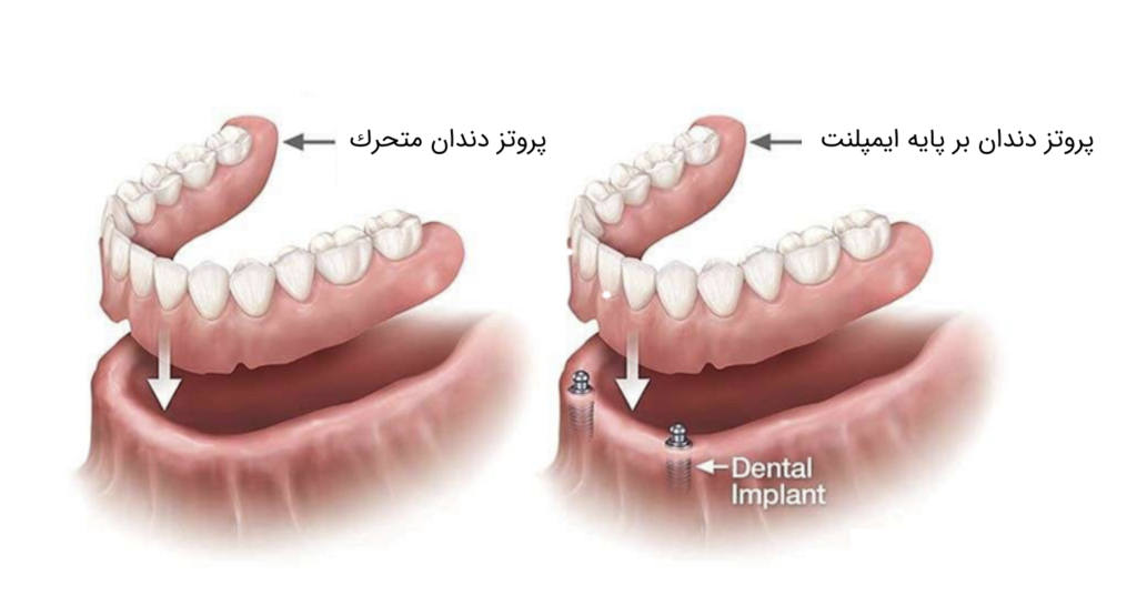 مقایسه پروتز دندان متحرک و پروتز دندان بر پایه ایمپلنت