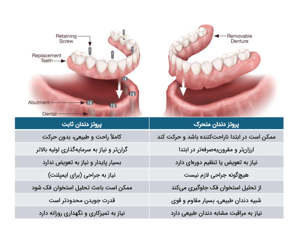 مقایسه دندان مصنوعی ثابت و متحرک