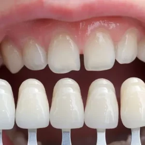 dental-veneers