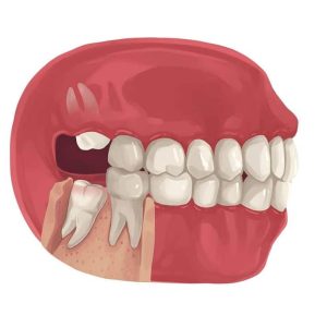 wisdom-tooth-partial-impact